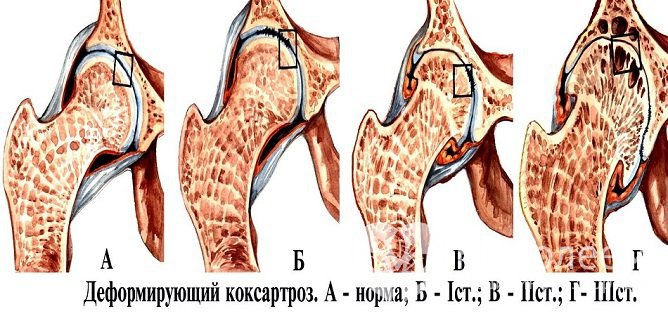 Артроз тазобедренного сустава разделяют на 3 степени