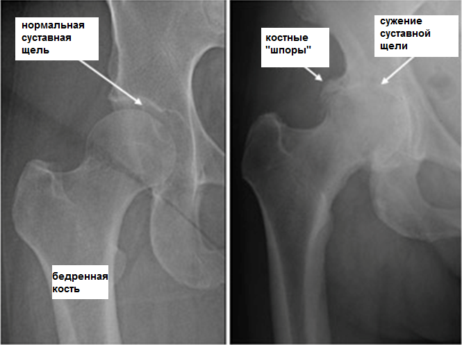 Артроз тазобедренного сустава на рентгеновском снимке