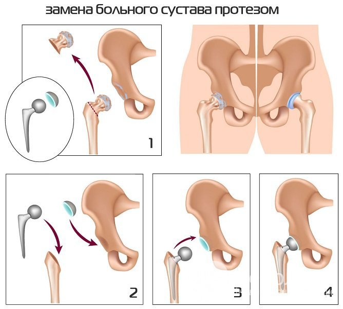 При 3 степени артроза показано эндопротезирование сустава