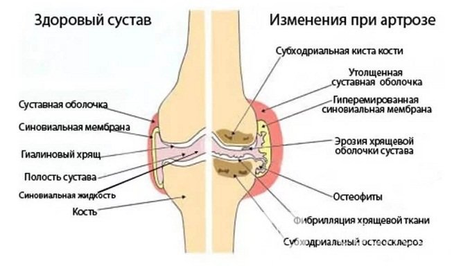 Механизм развития артроза