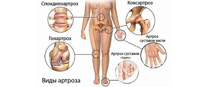 Виды артроза по локализации воспалительного процесса