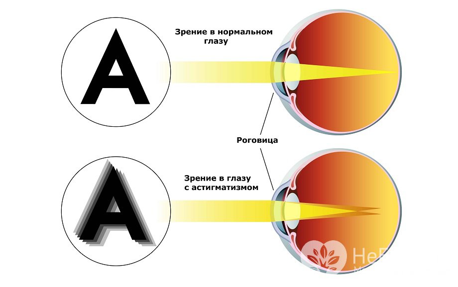 Признаки астигматизма у детей