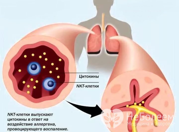 Признаки астматического бронхита