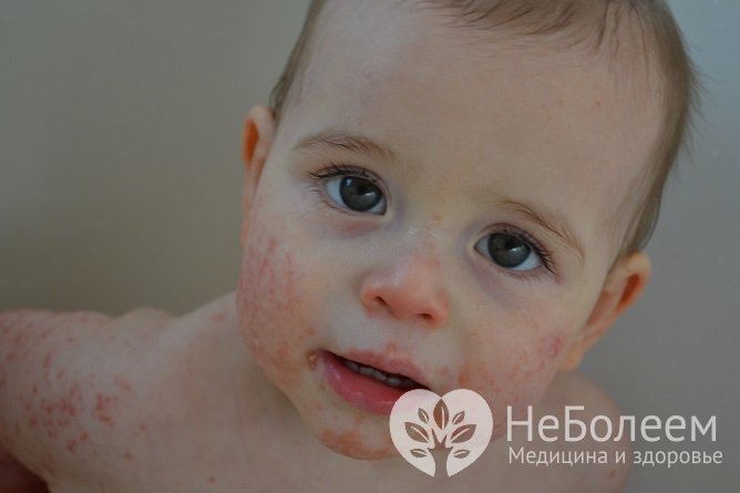 У детей астматический бронхит часто сопровождается аллергическими высыпаниями на коже