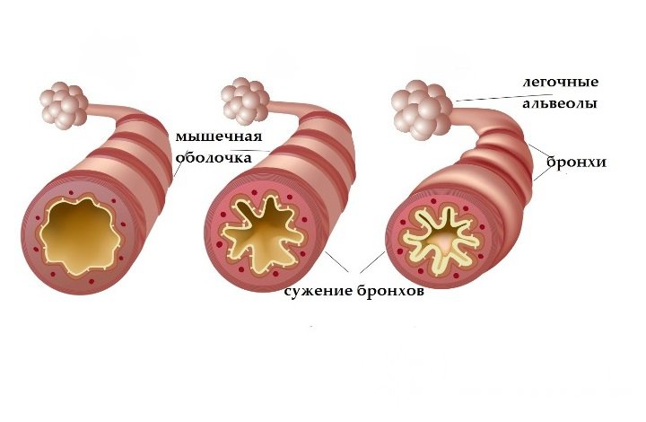 Признаки астматического статуса