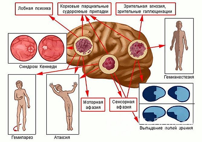 Очаговые симптомы астроцитом