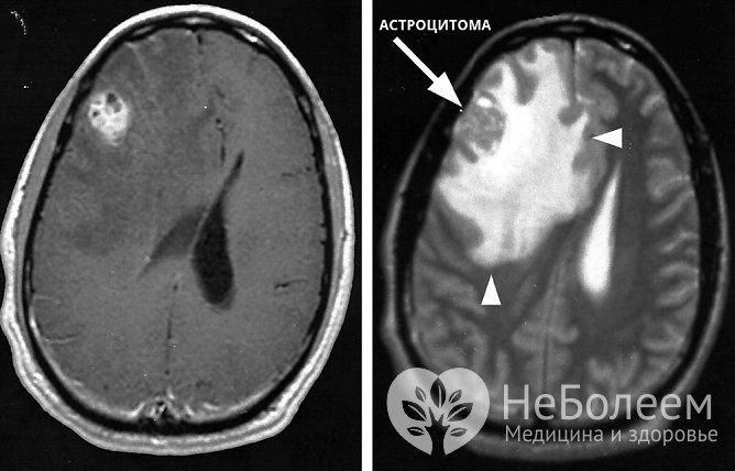 Для диагностики астроцитомы и ее особенностей проводится ангиография