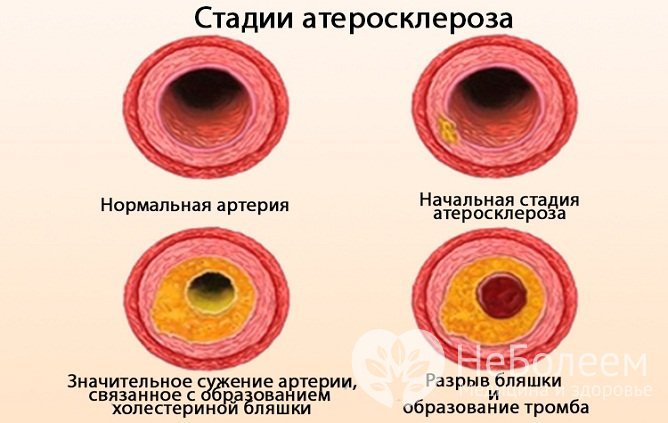 Стадии развития атеросклероза