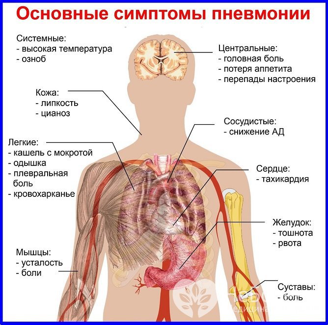 Основные симптомы атипичной пневмонии