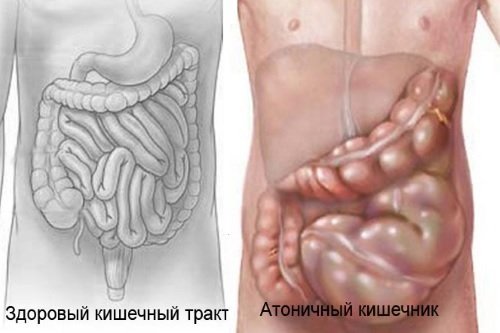 При атонии кишечника наблюдается низкий тонус его гладкой мускулатуры