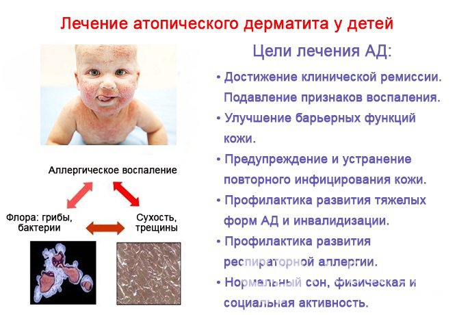 Цели лечения атопического дерматита у детей