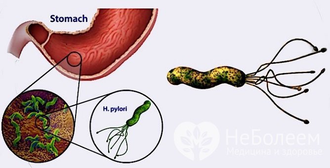 Одной из причин развития атрофического гастрита является поражение бактерией Helicobacter pylori