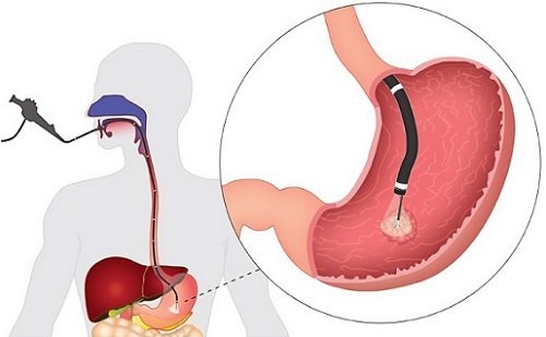 Биопсия слизистой оболочки желудка