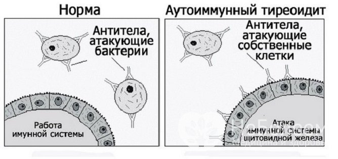 Аутоиммунный тиреоидит развивается, когда антитела распознают клетки щитовидной железы, как чужеродные