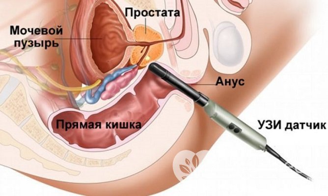 Своевременно выявить азооспермию поможет ТРУЗИ простаты