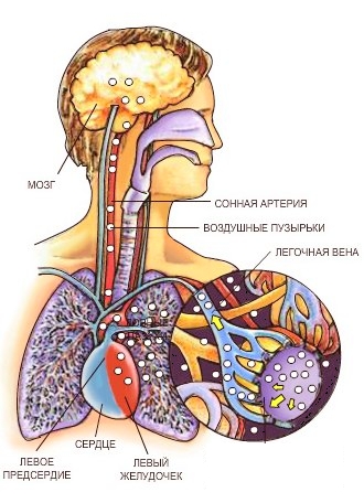 Баротравма легких