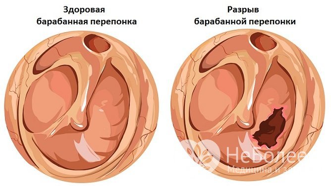 Баротравма уха может сопровождаться разрывом барабанной перепонки