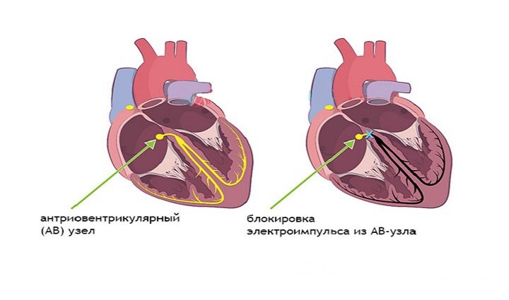 Признаки блокады сердца