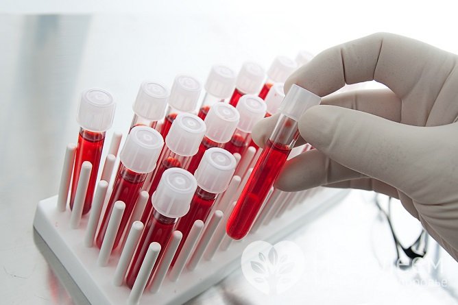 Общий анализ крови при болезни Бехчета показывает повышение СОЭ, умеренную анемию, нейтрофильный лейкоцитоз