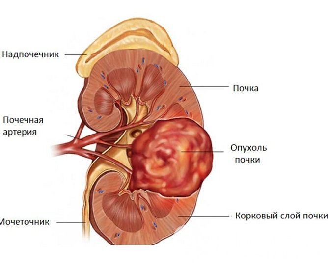 Опухоль почки может привести к поражению клеток коры надпочечника и как следствие – болезни Аддисона