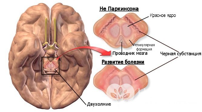 Развитие болезни Паркинсона