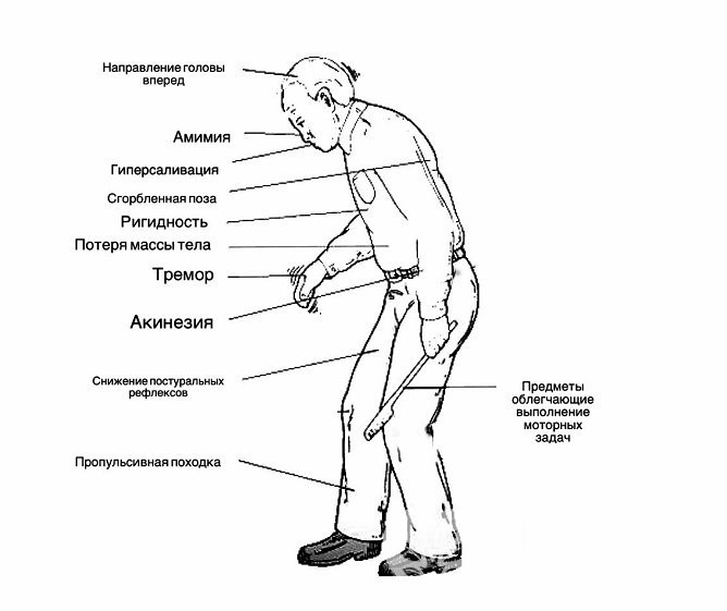 Проявления болезни Паркинсона