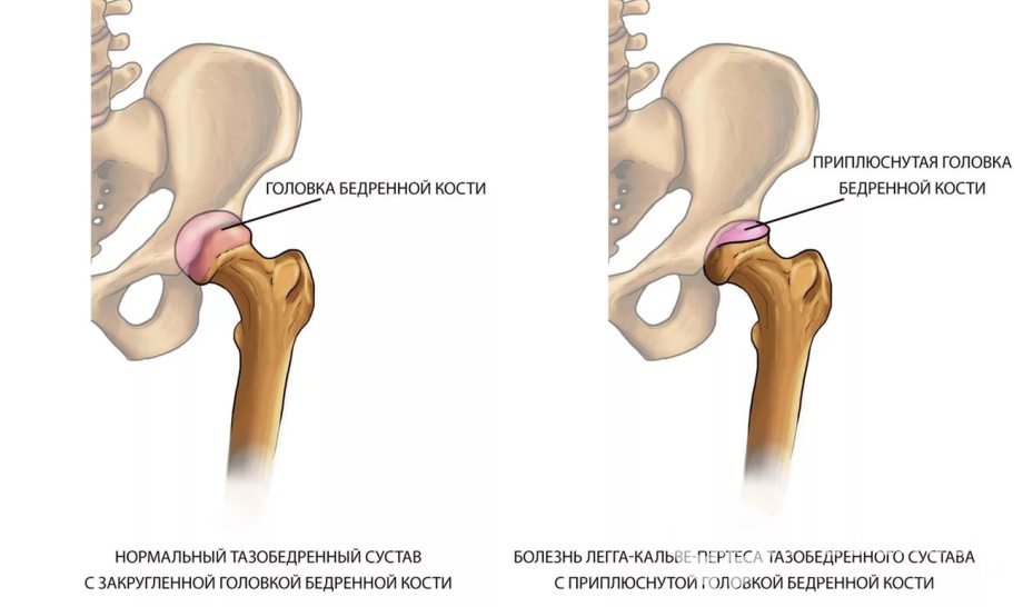 Признаки болезни Пертеса