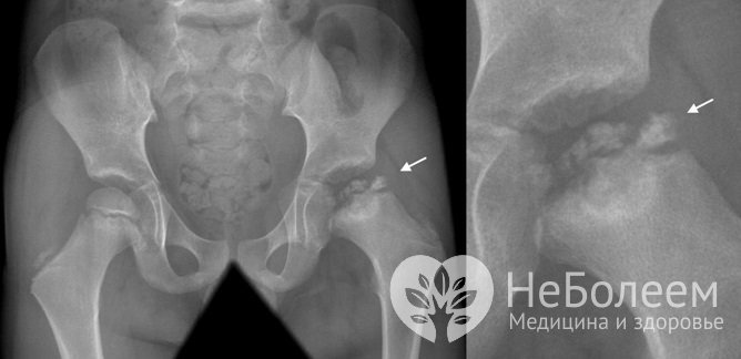 Болезнь Пертеса на рентгеновском снимке