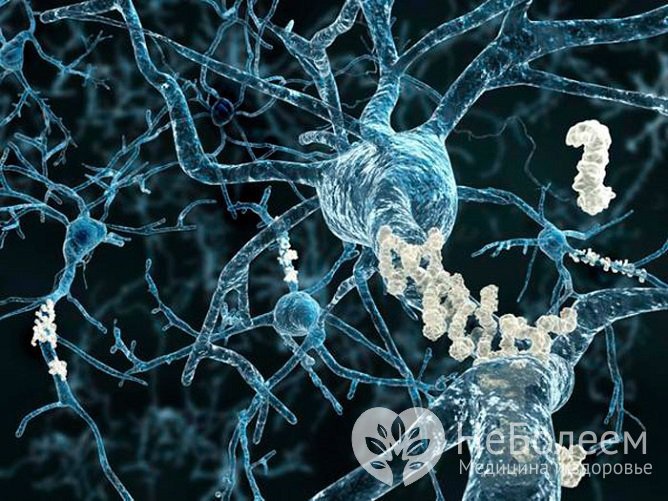 Отмирание нейронов в головном мозге при болезни Пика