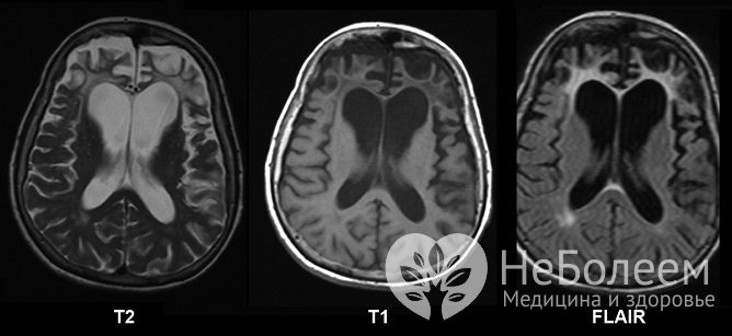 МРТ головного мозга женщины с болезнью Пика