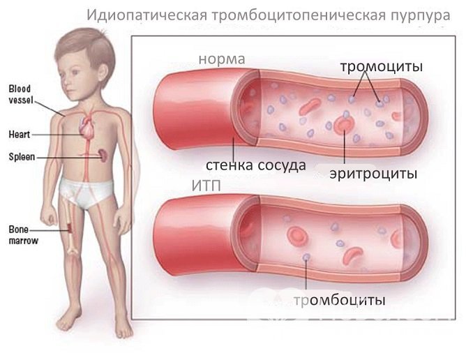 При болезни Верльгофа происходит нарушение образования тромбоцитов в костном мозге