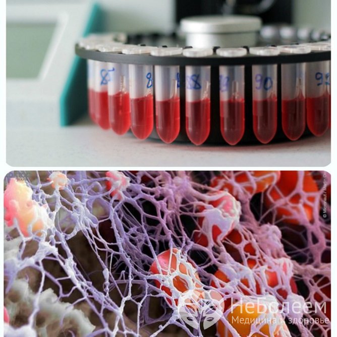 Снижение числа тромбоцитов дает основания подозревать болезнь Верльгофа