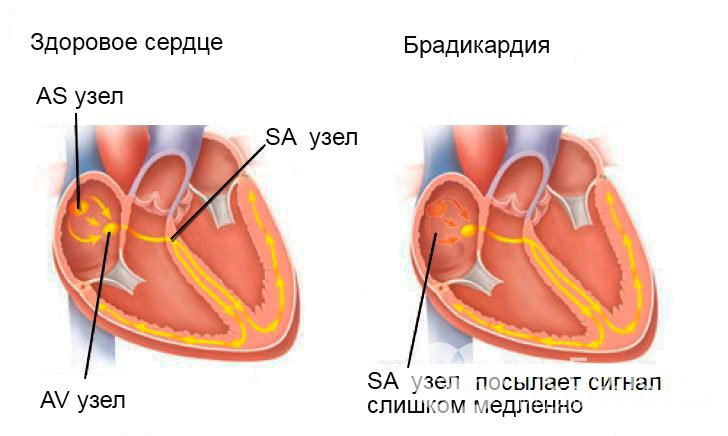 Признаки брадикардии