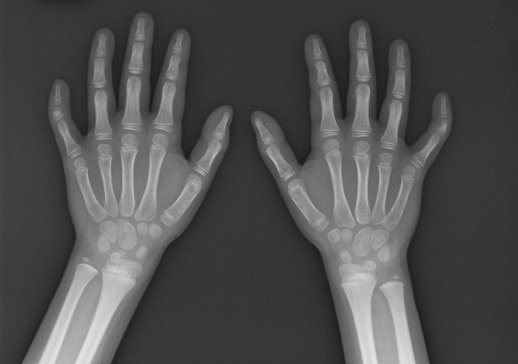Брахимезофалангия V пальца на рентгеновском снимке