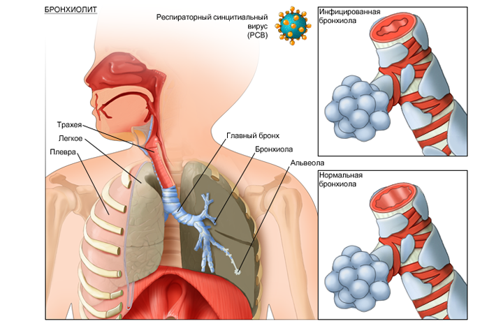 Признаки бронхиолита
