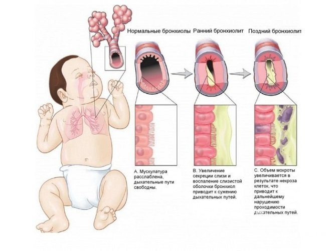 Стадии бронхиолита