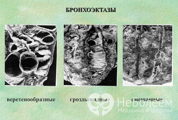 Разновидности бронхоэктазов по форме расширения бронхов