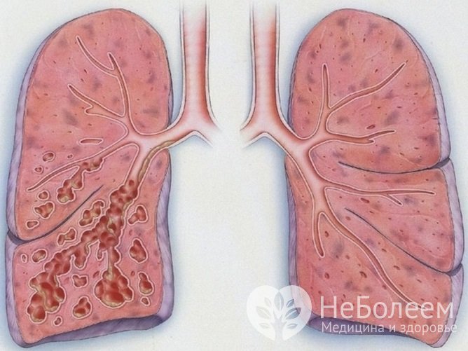 Структурные изменения в легких при бронхоэктактической болезни