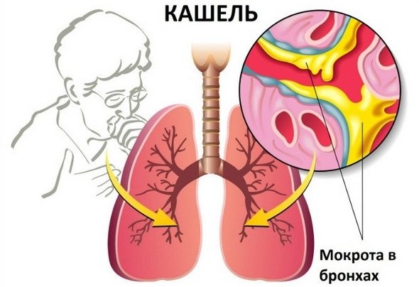 Основные симптомы бронхоэктактической болезни