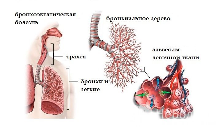 Признаки бронхоэктатической болезни