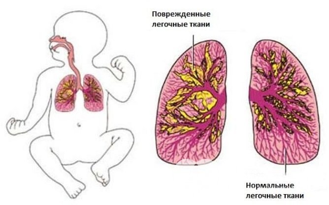 Поражение легочных тканей при бронхолегочной дисплазии