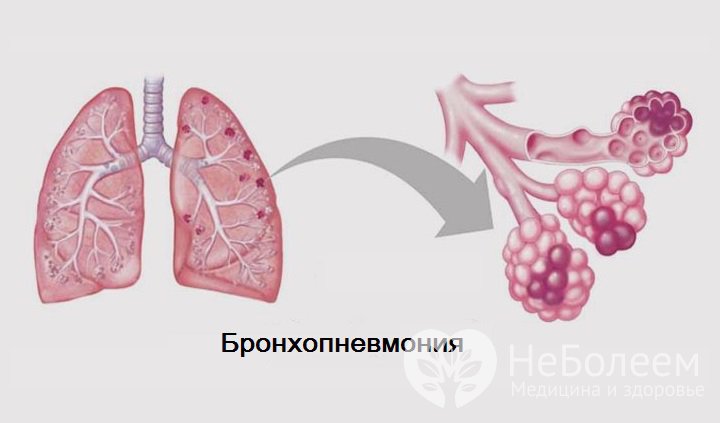 Легкое течение пневмонии. Очаговая пневмония бронхопневмония. Крупозная пневмония и бронхопневмония. Острая очаговая бронхопневмония. Крупозная бронхопневмония.