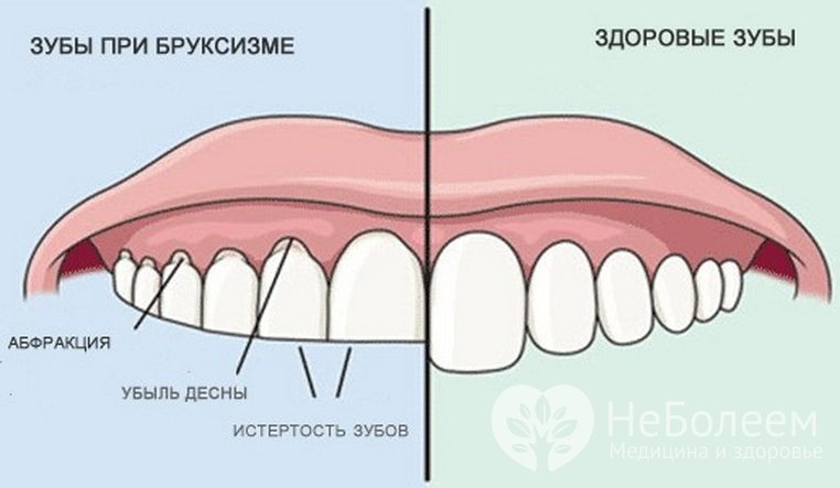 Симптомы бруксизма