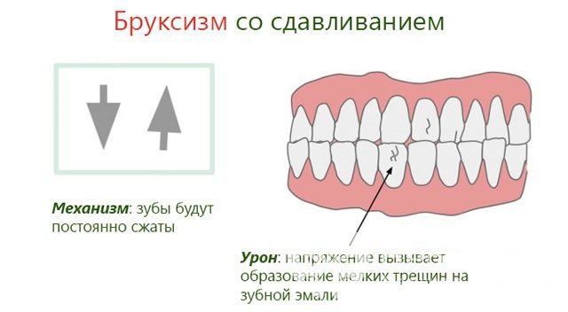 Бруксизм со сдавливанием способствует появлению микротрещин