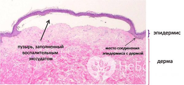 Микроструктура образца кожи больного буллезным эпидермолизом