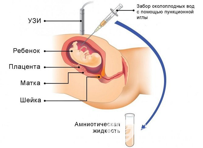Буллезный эпидермолиз можно диагностировать до рождения ребенка путем исследования амниотической жидкости