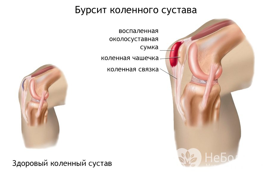 Признаки бурсита коленного сустава