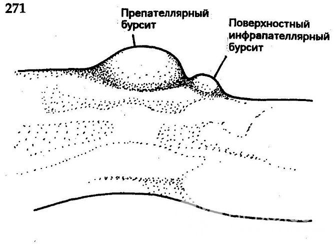 Разновидности коленного бурсита