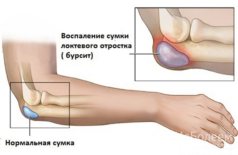 Признаки бурсита локтевого сустава