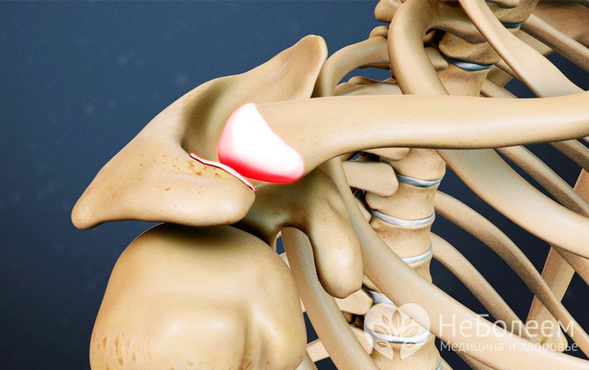 Признаки бурсита плечевого сустава